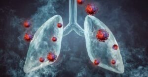 Read more about the article Ayurvedic treatment for Lung Cancer in Mumbai, Navi Mumbai & Thane