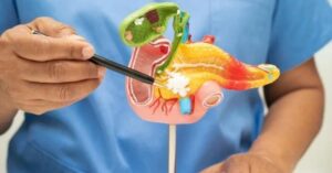 Read more about the article Ayurvedic treatment for Pancreas Cancer in Mumbai, Navi Mumbai & Thane